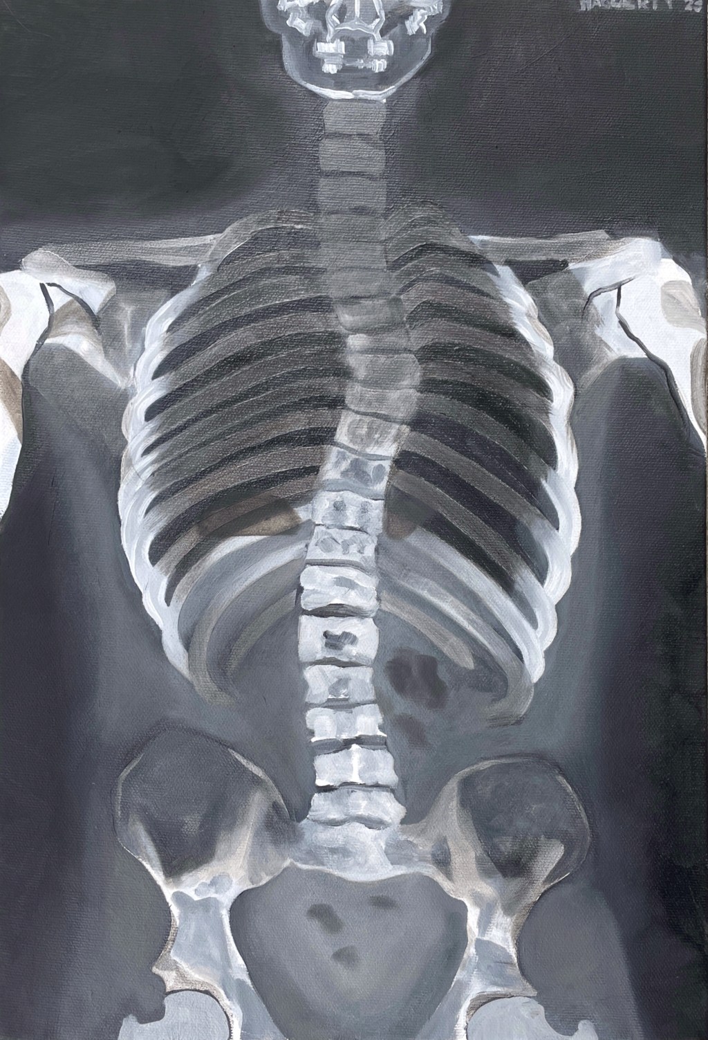 Scoliosis